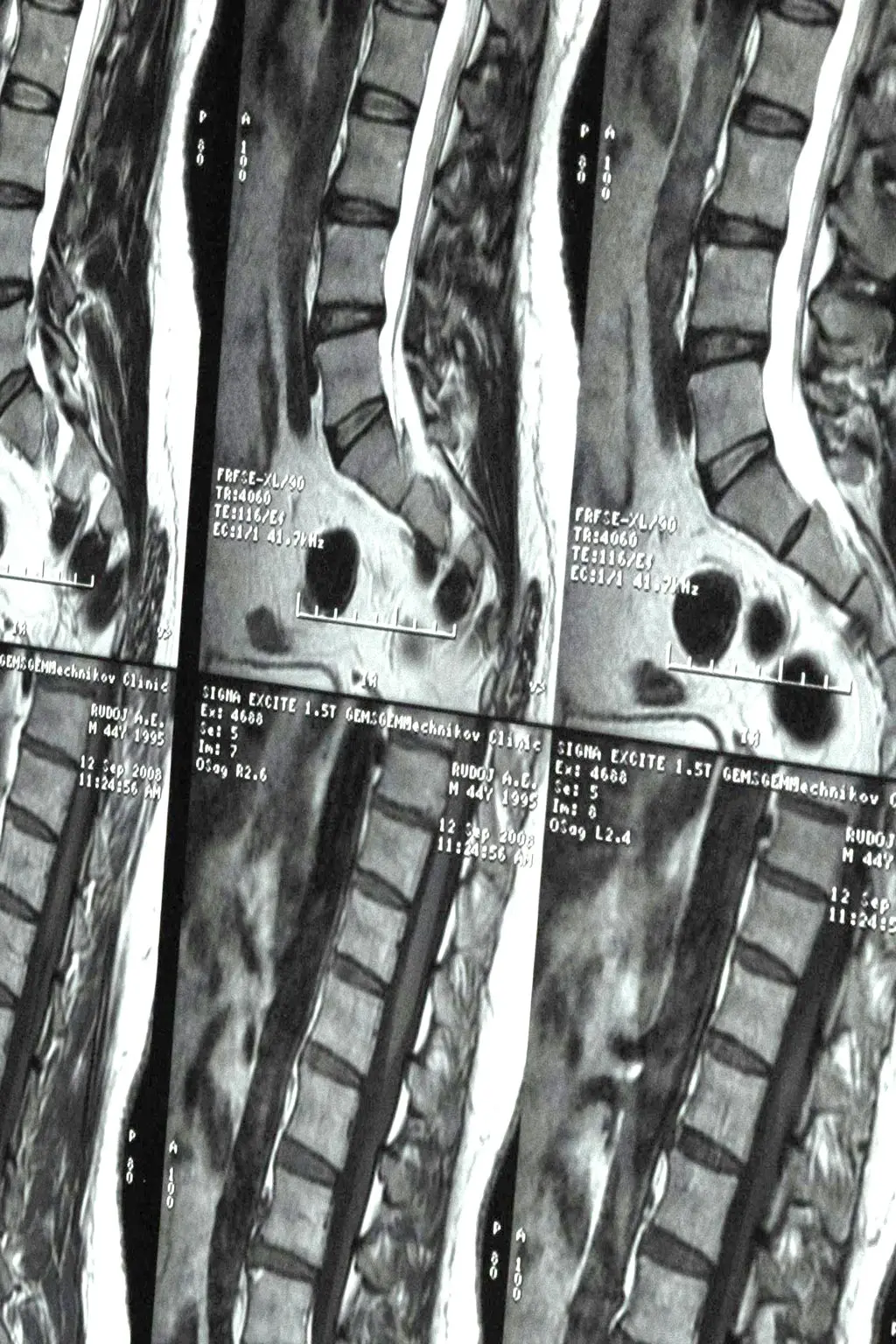 Spinal Cord Injury — James & Bradley Law Firm